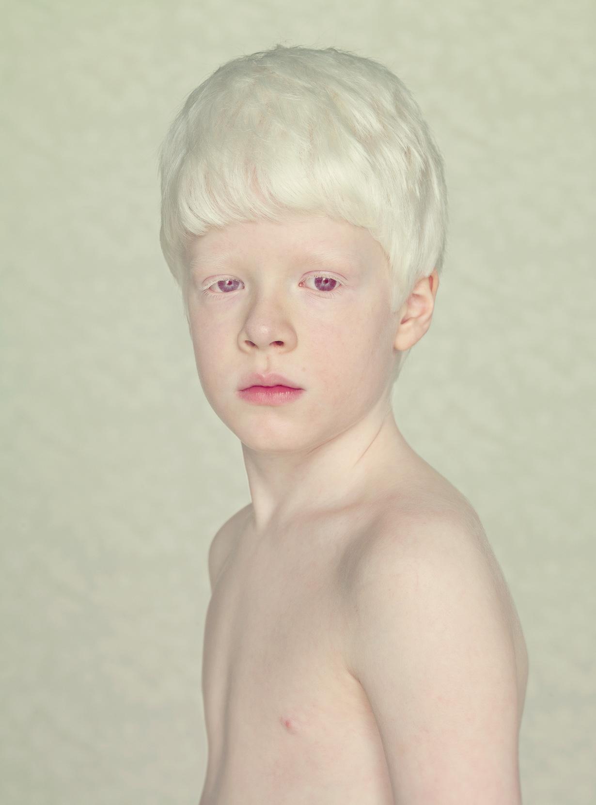 Как люди рождаются альбиносами. Тотальный альбинизм. Альбиносы люди. Температурно чувствительный альбинизм.